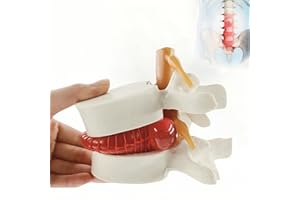 ZITREOXN Human Anatomical Lumbar Disc Herniation Model 1.5 Times Life Size Lumbar Spine Model for Teaching and Learning (1pc Spine and Disc Model)