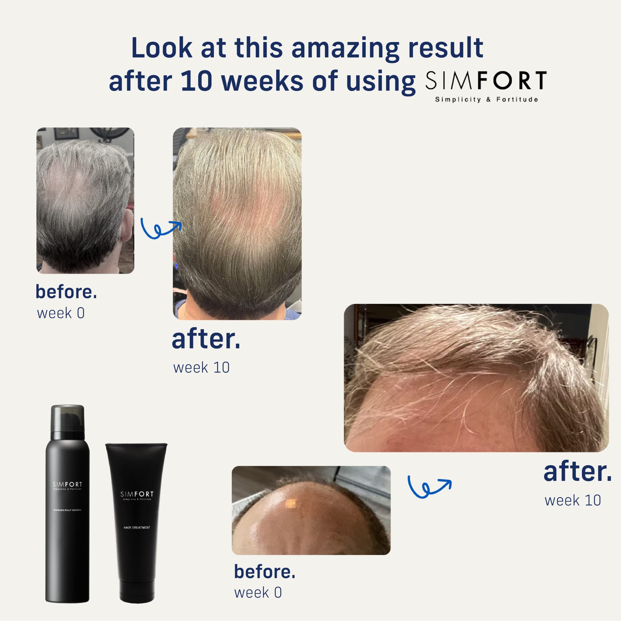 SIMFORT Sparkling Scalp Shampoo for Thinning Hair and Loss - Growth Treatment (3 Pack)