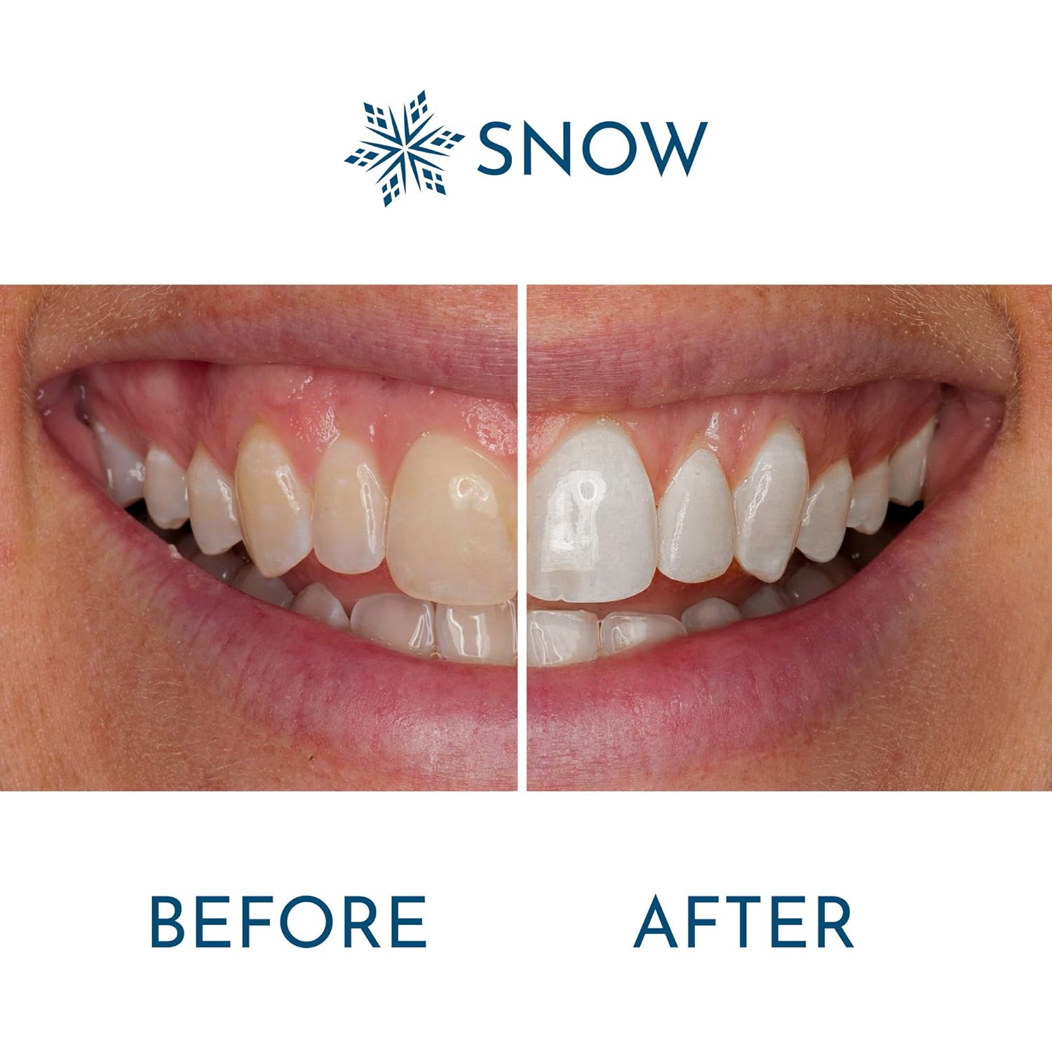 Snow Wireless Teeth Whitening Kit with LED Light | All-in-One at Home Whitener System - Safe for Sensitive Teeth, Braces, Crowns & Veneers - Just 9 Minutes a Day to a Whiter, Brighter Smile: Beauty