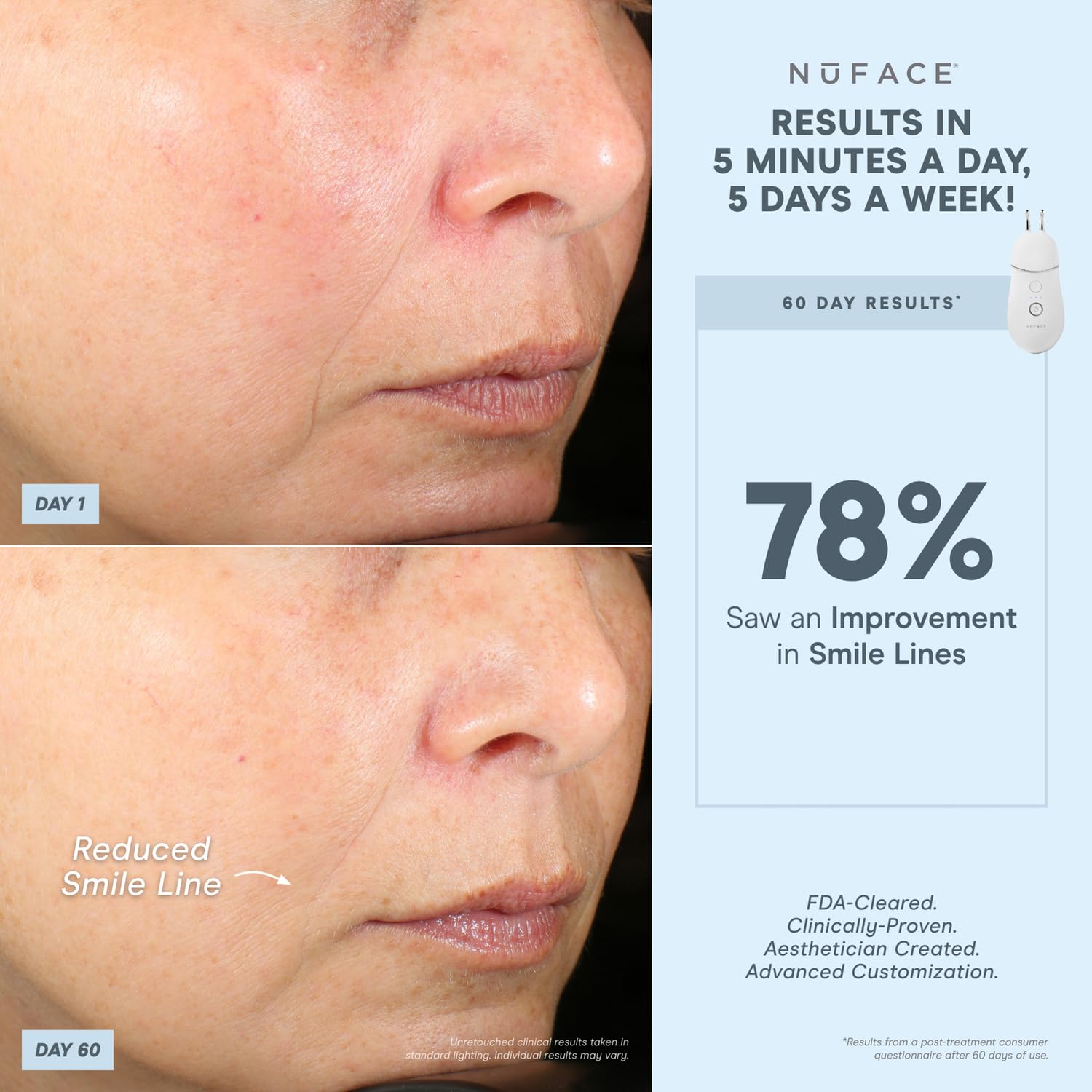 NuFACE TRINITY+ Effective Lip & Eye Attachment for Microcurrent Facial Device - FDA Cleared At Home Eye Lift & Smile Lines Treatment to Tighten & Tone Hard-to-Reach Areas Around Mouth and Eyes