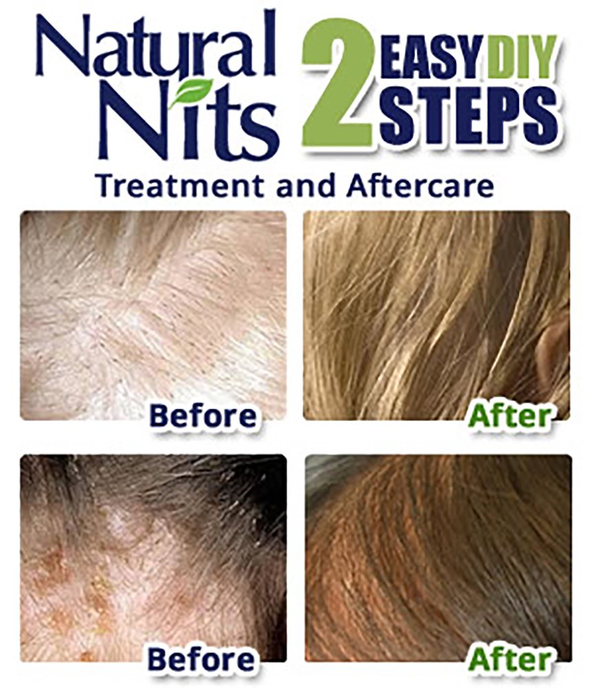 Amazoncom Natural Nits Super Lice Treatment Shampoo All