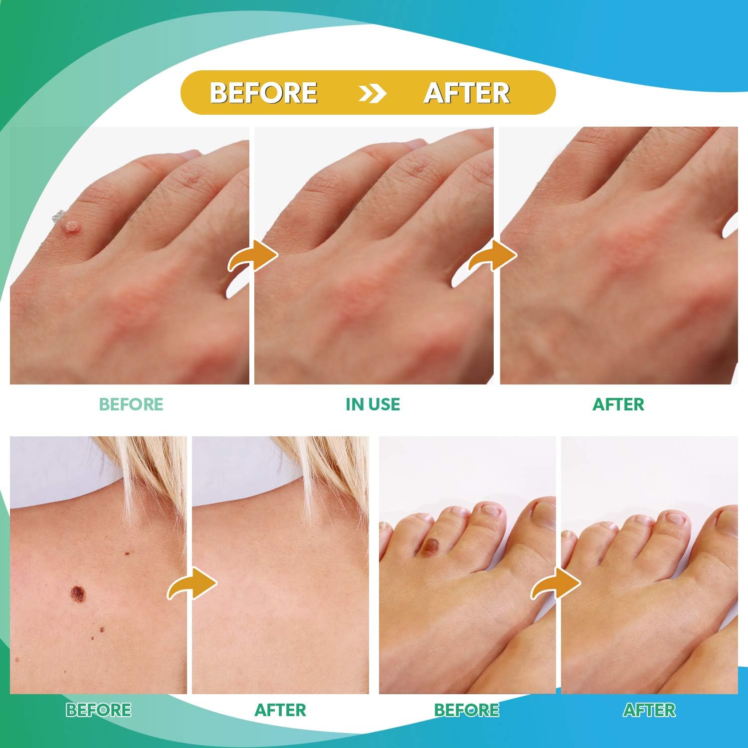 Ulensy Skin Tag Remover Pads, Effective Skin Tags Removal Treatment, Best Skin Tag Remover 42 Pads: Health & Personal Care