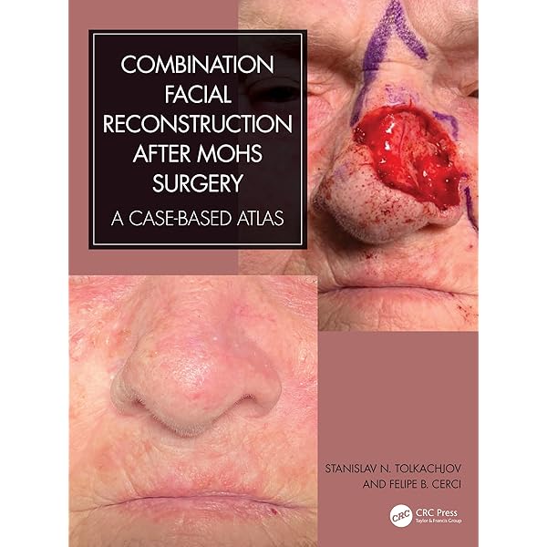 Amazon.com: Local Flaps in Facial Reconstruction E-Book eBook