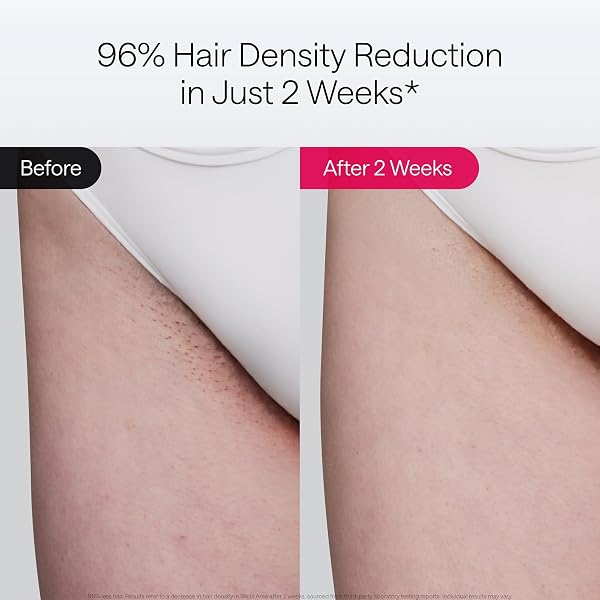 ULIKE LASER HAIR REMOVAL AIR 10 DELUXE VERSION IPL FOR FOR WOMEN AND MEN WITH ICE-COOLING TECHNOLOGY, NEALY PAINLESS AND PERMANENT HAIR REDUCTION, AT HOME HAIR REMOVAL IN 10MINS WITH SKIN SENSOR