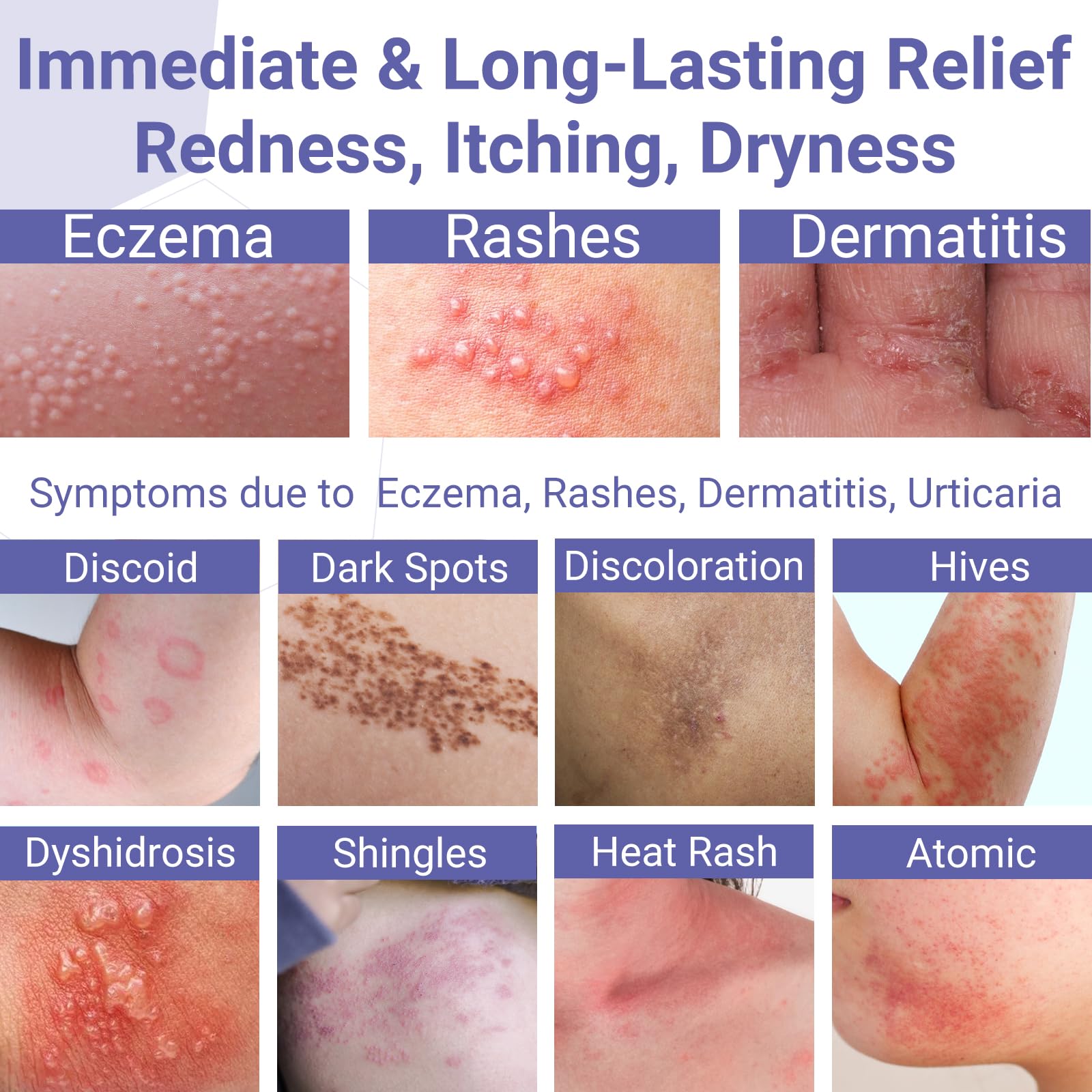 Embolic Rash Name Mua ishancare Eczema Cream, Eczema-Prone Skin Soothing & Moisturizing ...