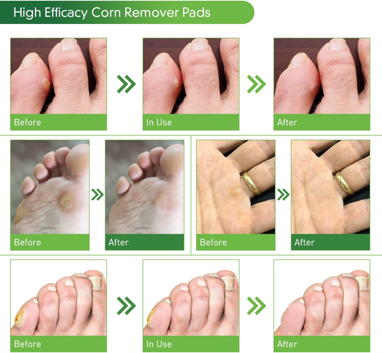 Corn Remover, 24 Corn Remover Pads, Toe Corn and Callus Removal, Corn Treatment Pads, Corn Remover Pads for Foot Corn Removal, 24 Pads: Health & Personal Care