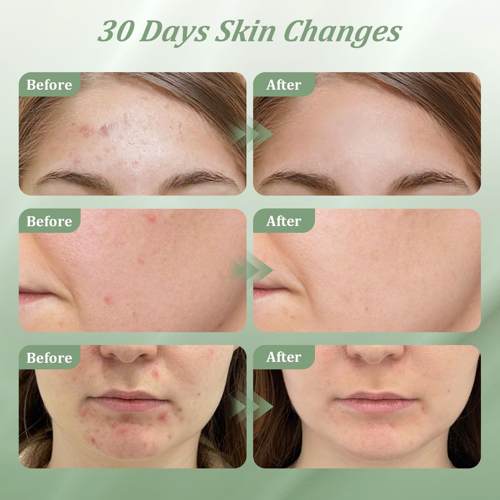2% Salicylic Acid Acne Treatment Cream for Face Back/Butt/Body,Spot Treatment for Pimples,Face Blemishes,Blackheads,Oil Control,Ingredients are Natural,Suitable for Teenagers/Women/Men（30g）