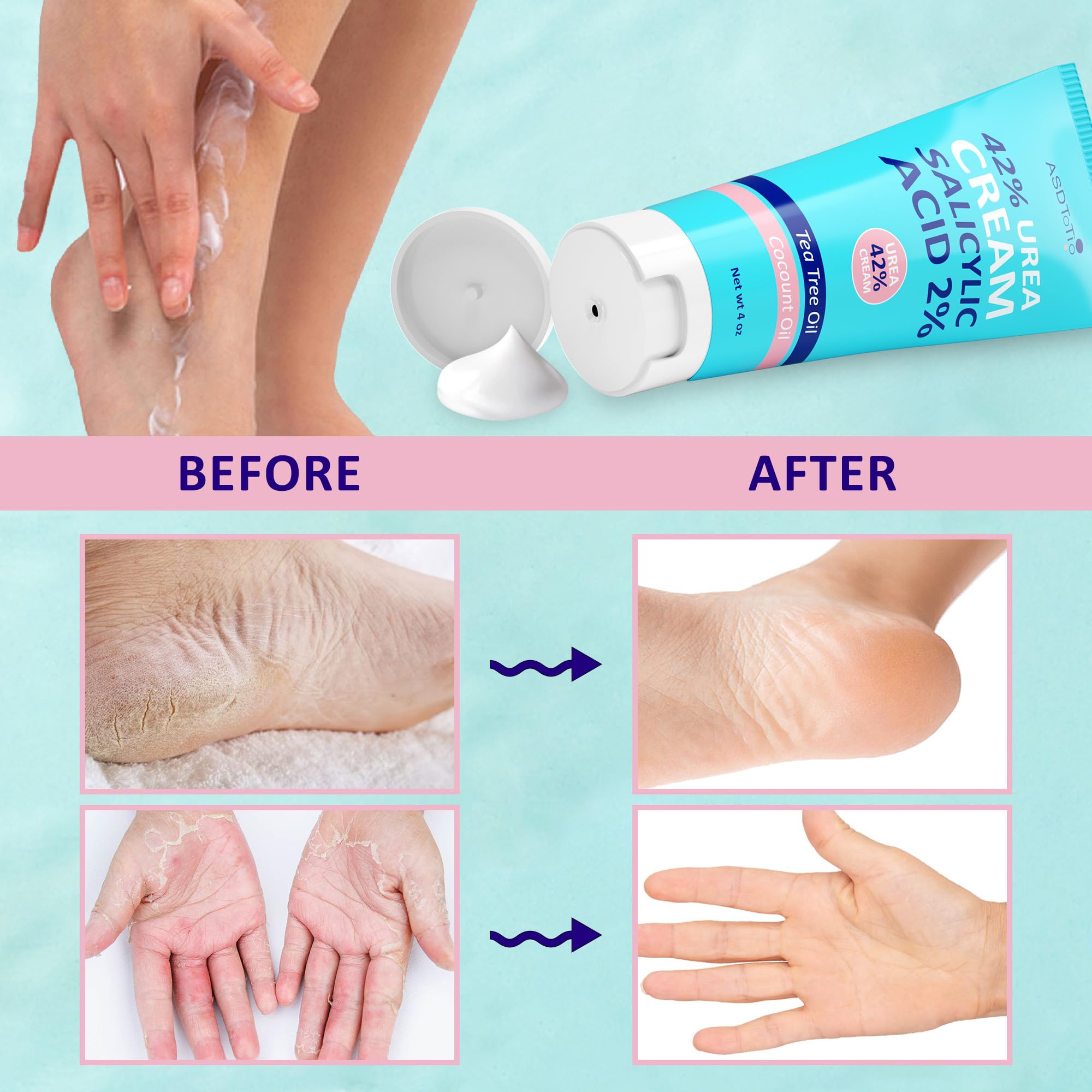Urea Cream 42% - Foot Care for Dry Cracked Heels, Foot Lotion - With 2% Salicylic Acid, Tea Tree Oil, Shea Butter, Aloe Vera - For Feet, Hands, Heels, Elbows, Knees and More - 4 oz