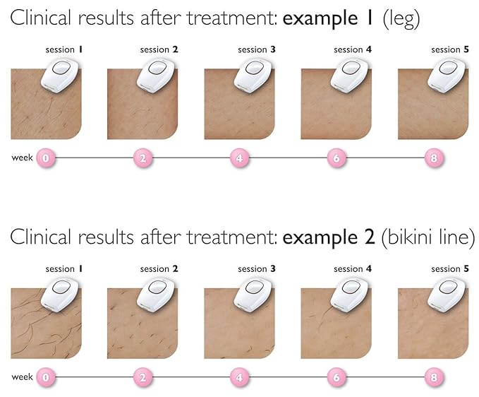 philips laser hair removal face