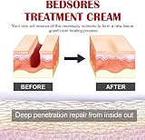 ChengJin Bed Sore Cream - Pressure Sore Relief & Cold Sore Treatment view 2