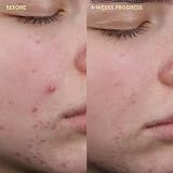 BYOMA Blemish Clearing Cleanser 175ml for Acne-Prone Skin view 6