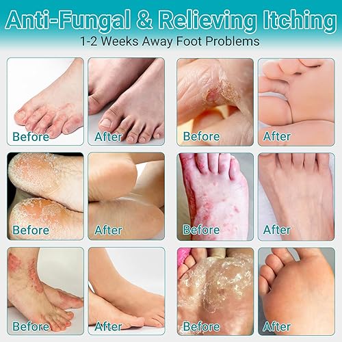 Athletes Foot Cracking Toes Athletes Foot Treatment Cream, Maximum