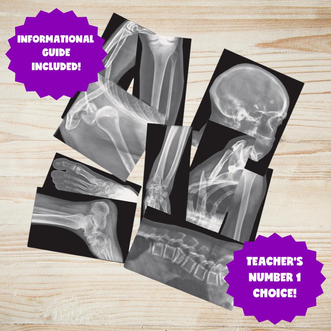 Roylco Broken Bones X-Ray Set, Projector Display Compatible, 15 X-Rays