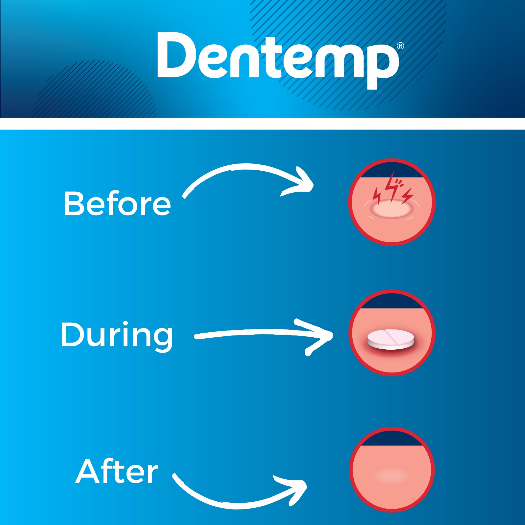 Dentemp Canker Sore Medicine 2pk Canker Cover - Oral Pain Reliever (12 Count) - Treatment to Relieve Canker Pain, Mouth Sores & Mouth Irritation - Fast Acting Canker Sore Relief Tablets for Adults