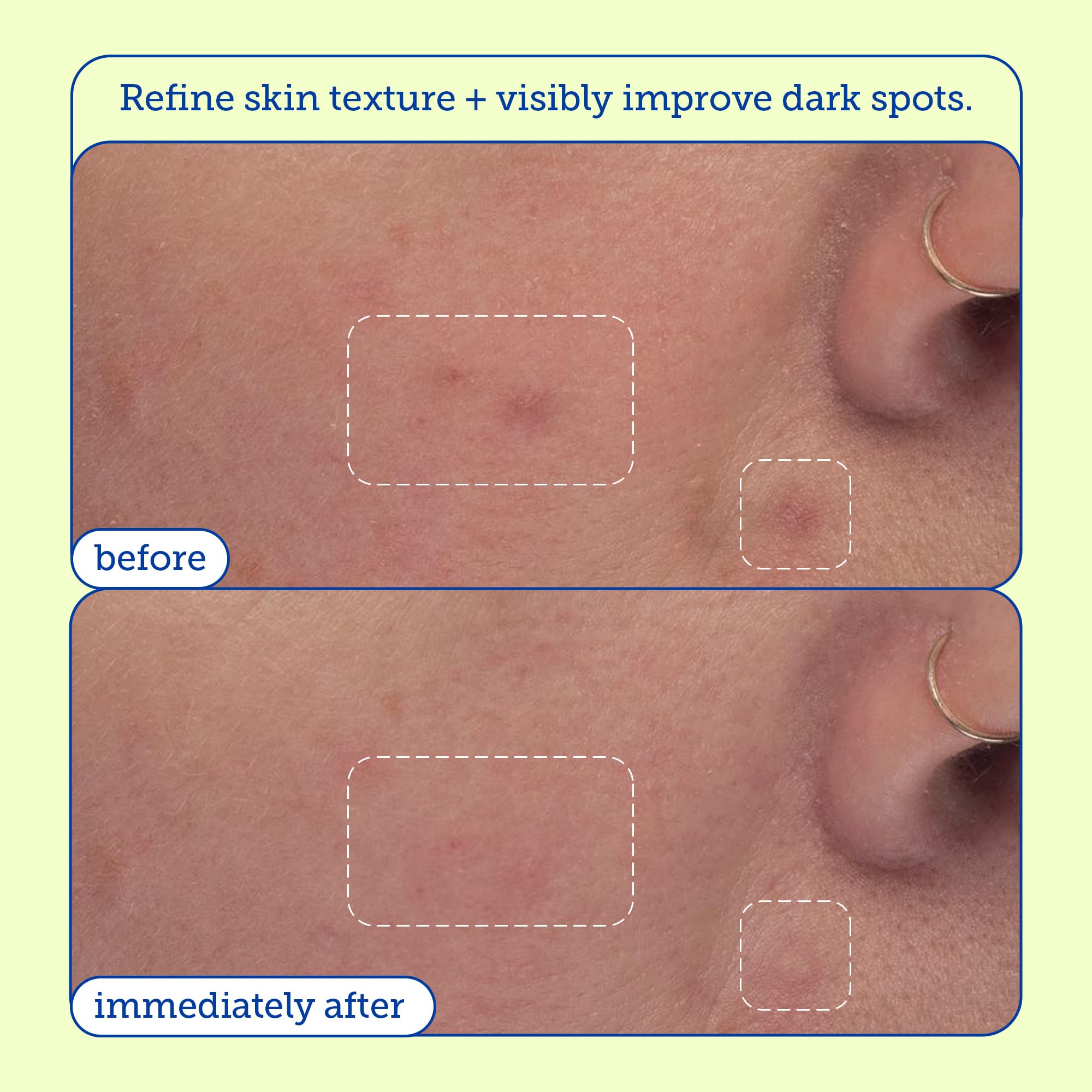 Skinfix AHA/BHA Niacinamide Exfoliating Pads - 60 Pads - Visibly Reduces Discoloration, Removes Dead Skin, Releases Ingrown Hairs & Unclogs Pores - Vegan, Cruelty Free