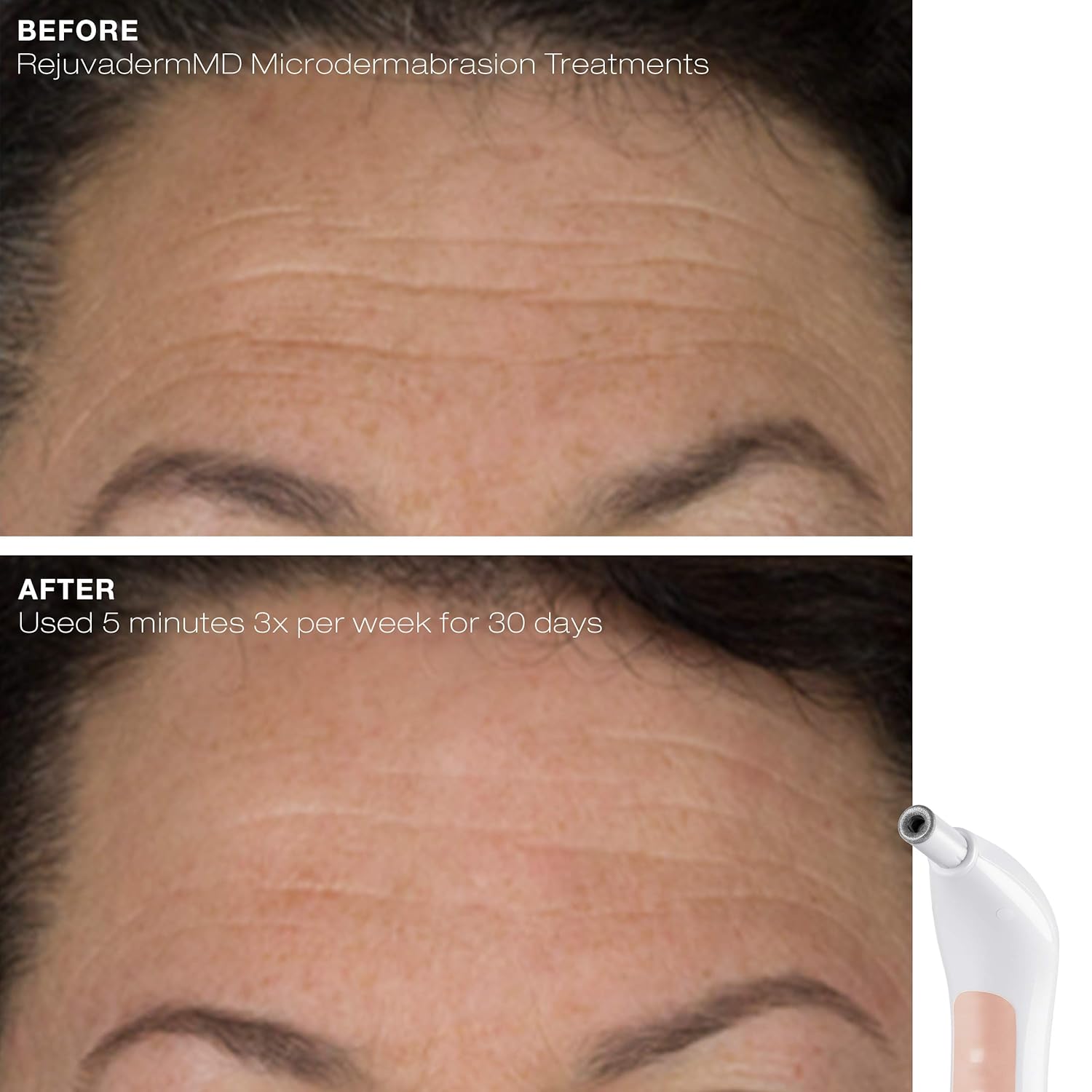 Trophy Skin RejuvadermMD - Microdermabrasion Machine On-The-Go: Beauty