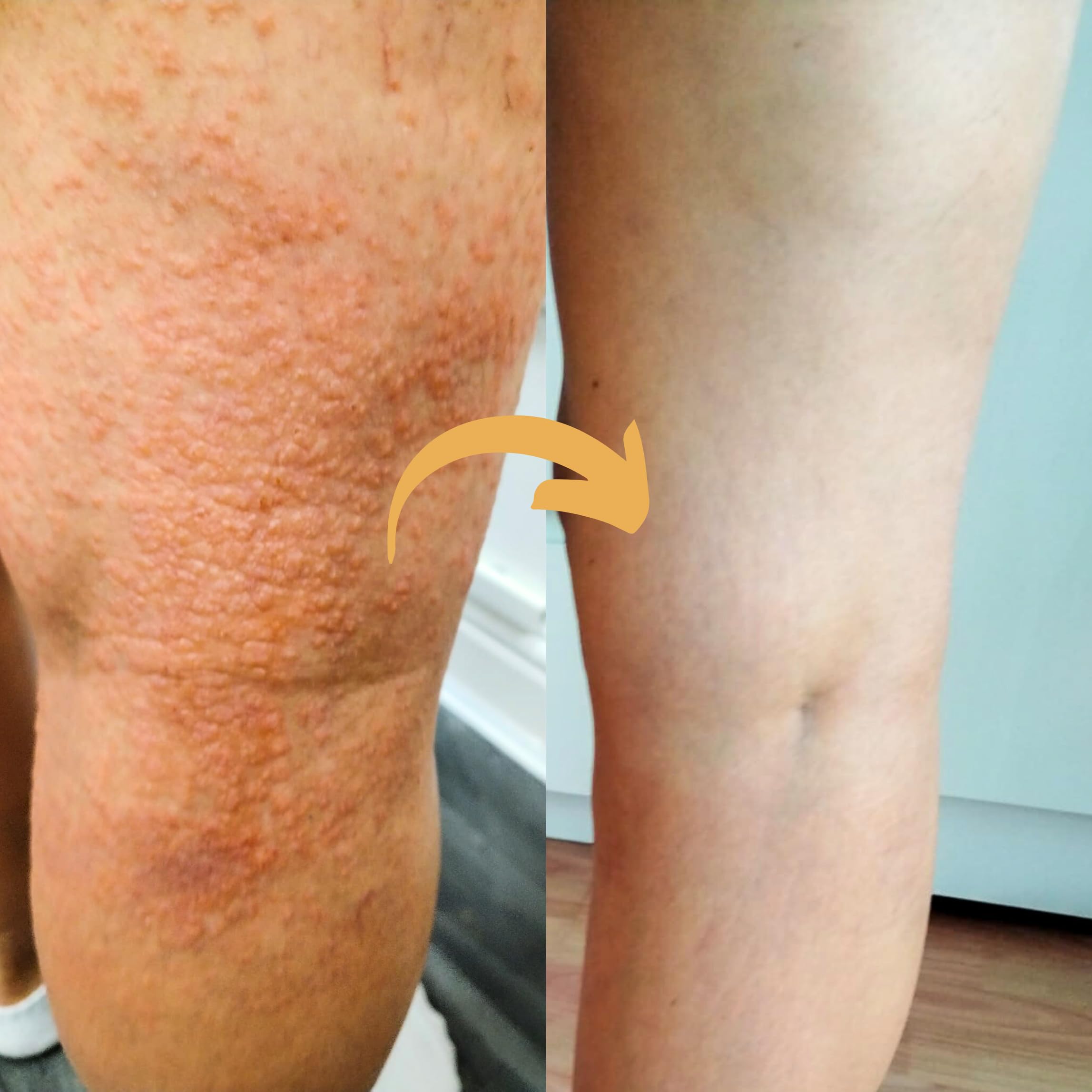 Strength & Spices Psoriaskin Supplement, Immune System Booster with 31 Powerful Ingredients and Amino Acids, Soothes Red, Flaky Skin, 1000 mg, 60 Vegan Capsules