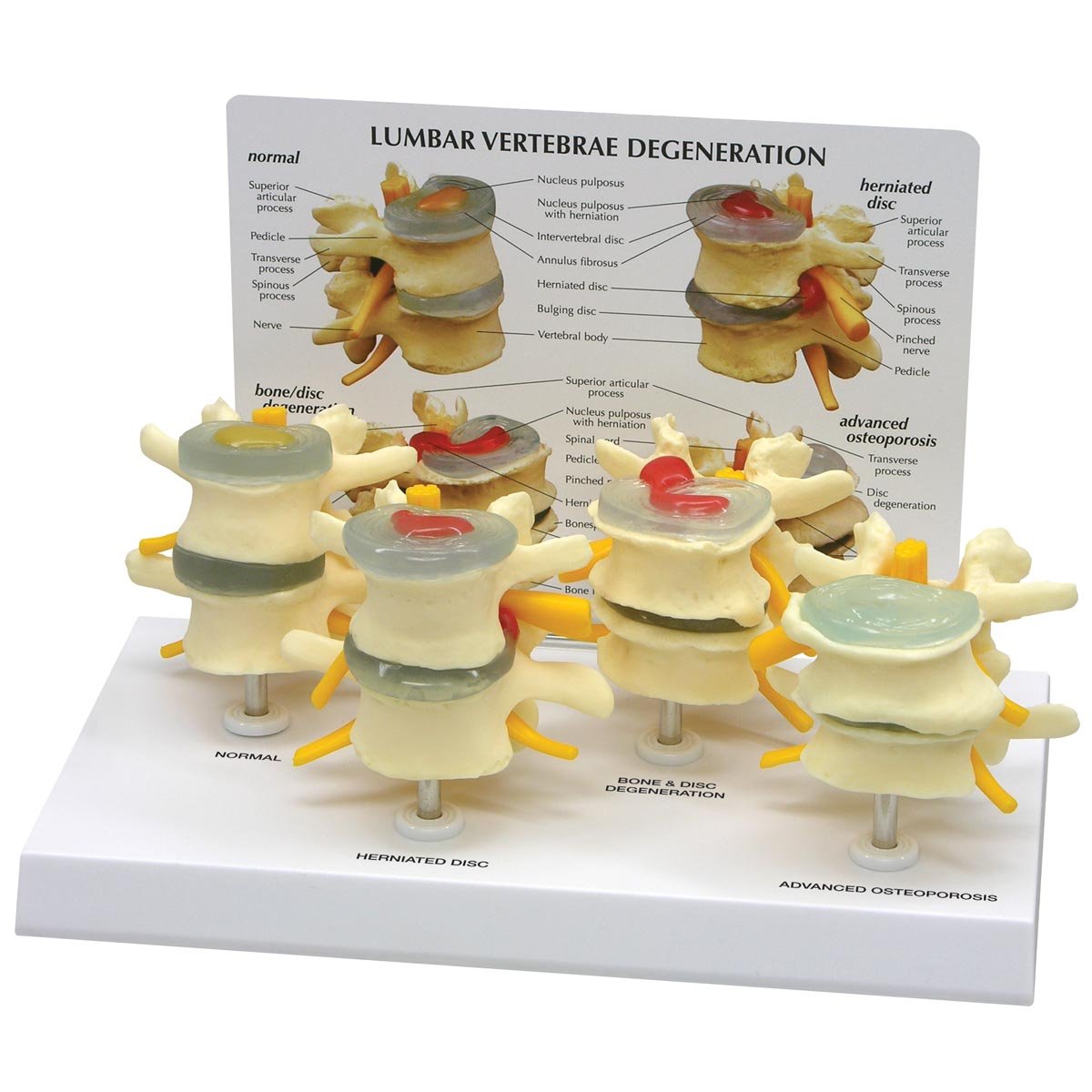 3B Scientific 4-Stage Vertebrae Model Set