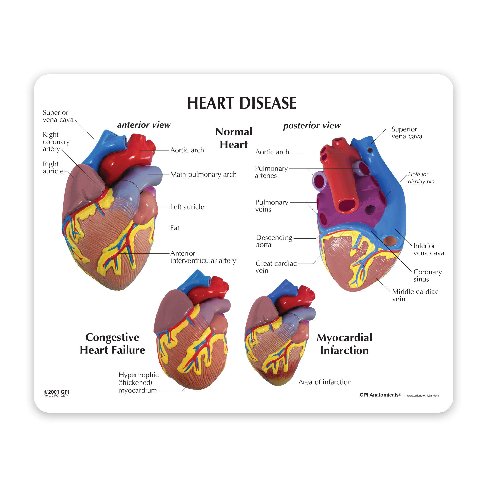 Mua GPI Anatomicals - 3-Piece Mini Heart Model Set, Normal and Diseased ...