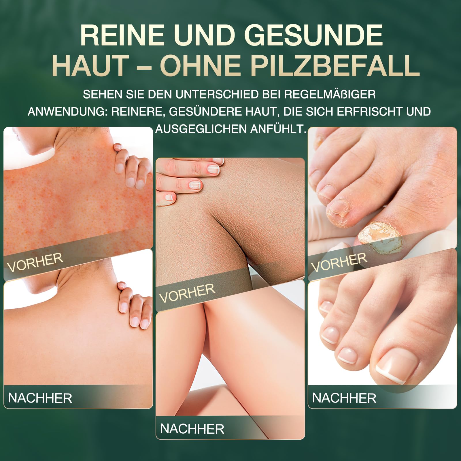 Teebaum Duschgel, lindert Pilz Juckreiz, Schuppen, Akne am Rücken, Fußpilz und Körpergeruch, Antimykotisches Duschgel mit Pfefferminz und Eukalyptusöl, 300 ml 4
