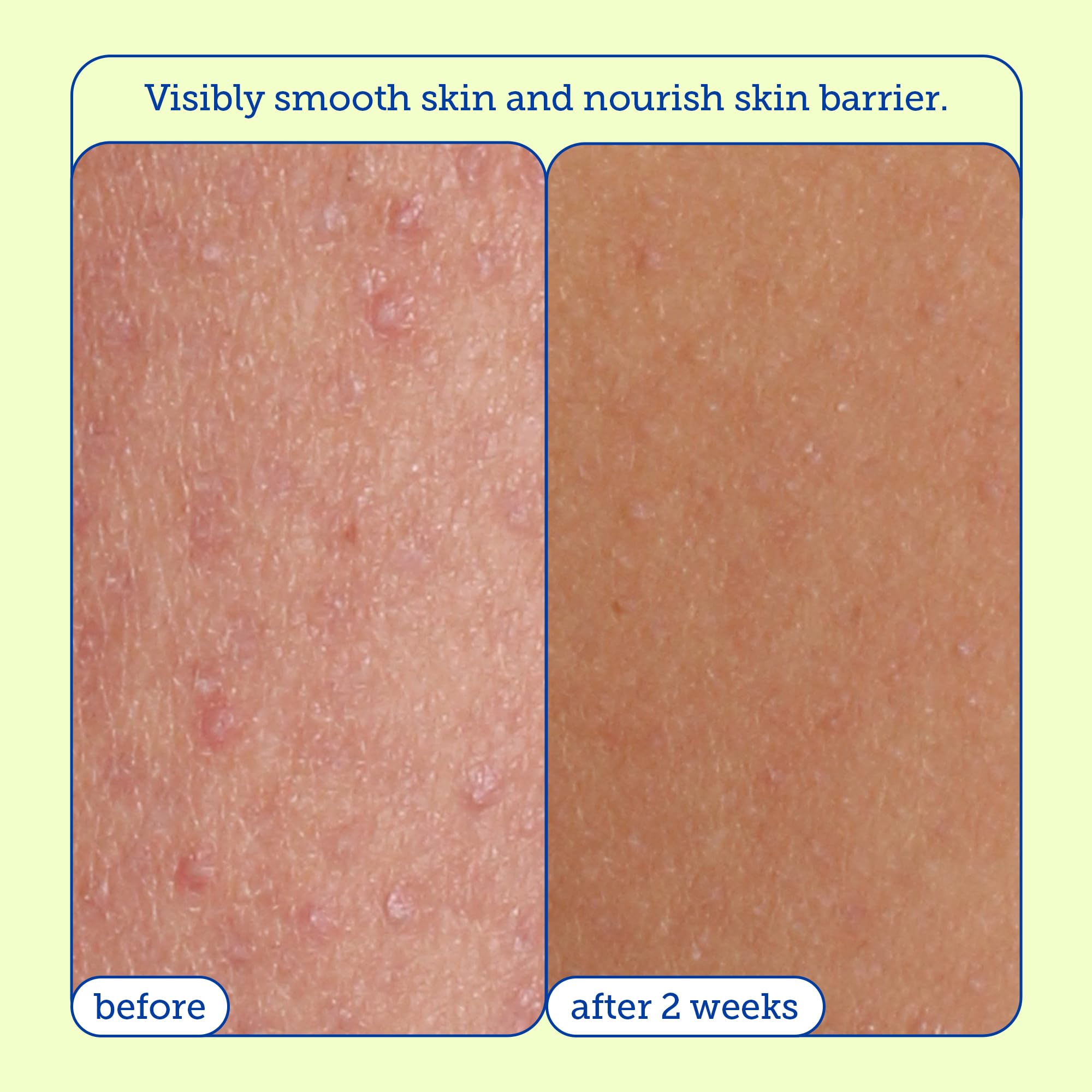 Skinfix AHA/BHA Renewing Body Cream - 10 oz - Skin-Softening Moisturizer with Gentle Exfoliation - Boosts Glow & Radiance - Vegan, Cruelty Free