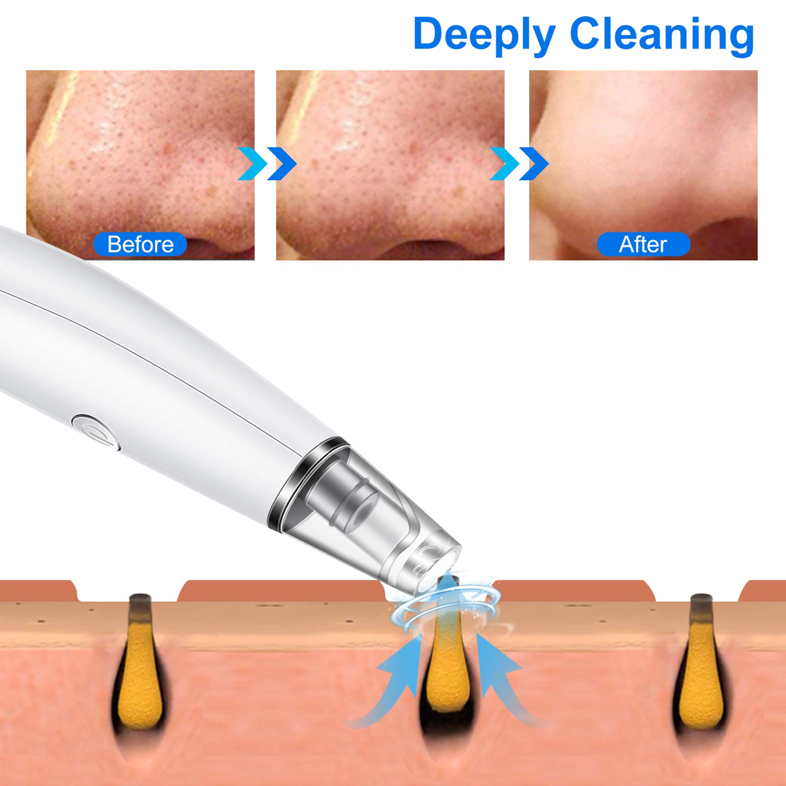 Blackhead Remover Vacuum, Pore Vacuum with 5 suction level, Powerful