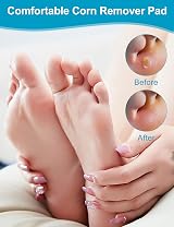 MQFORU Corn Remover Pads 28Pcs Foot Wart Remover Patch view 5