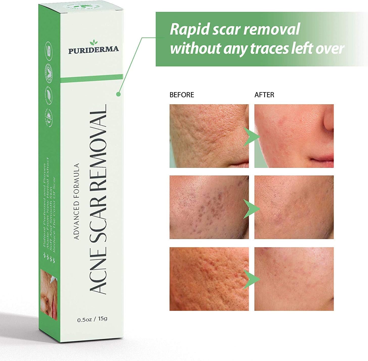 Scar Removal Cream - Advanced Treatment