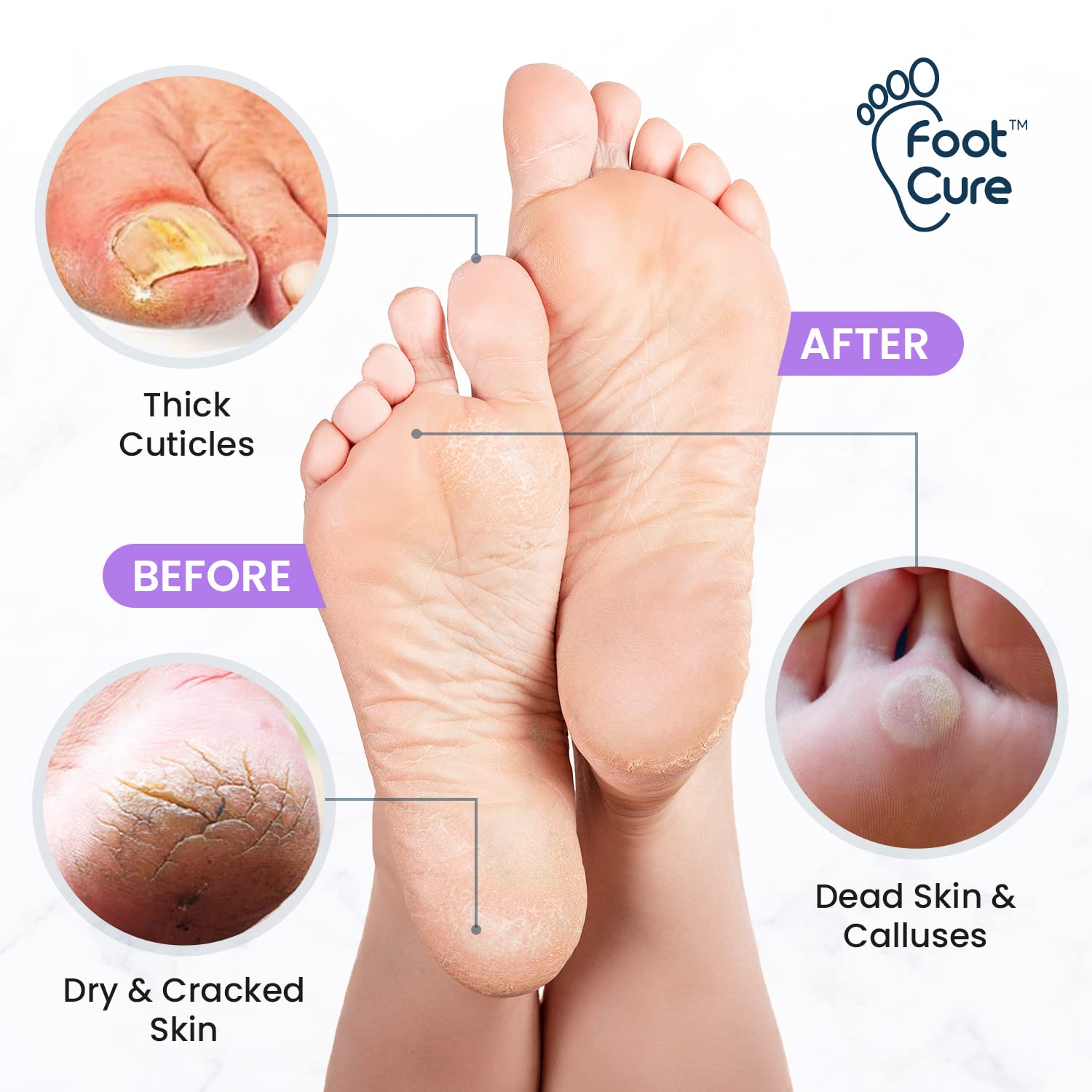 Lavender Foot Soak & Callus Remover Gel Kit - Extra Strength Callus Remover Gel for Feet, Remove Calluses with Epsom Salts, Dry Cracked Heels & Tea Tree Oil Foot Cream - Moisturizing Athletes Foot