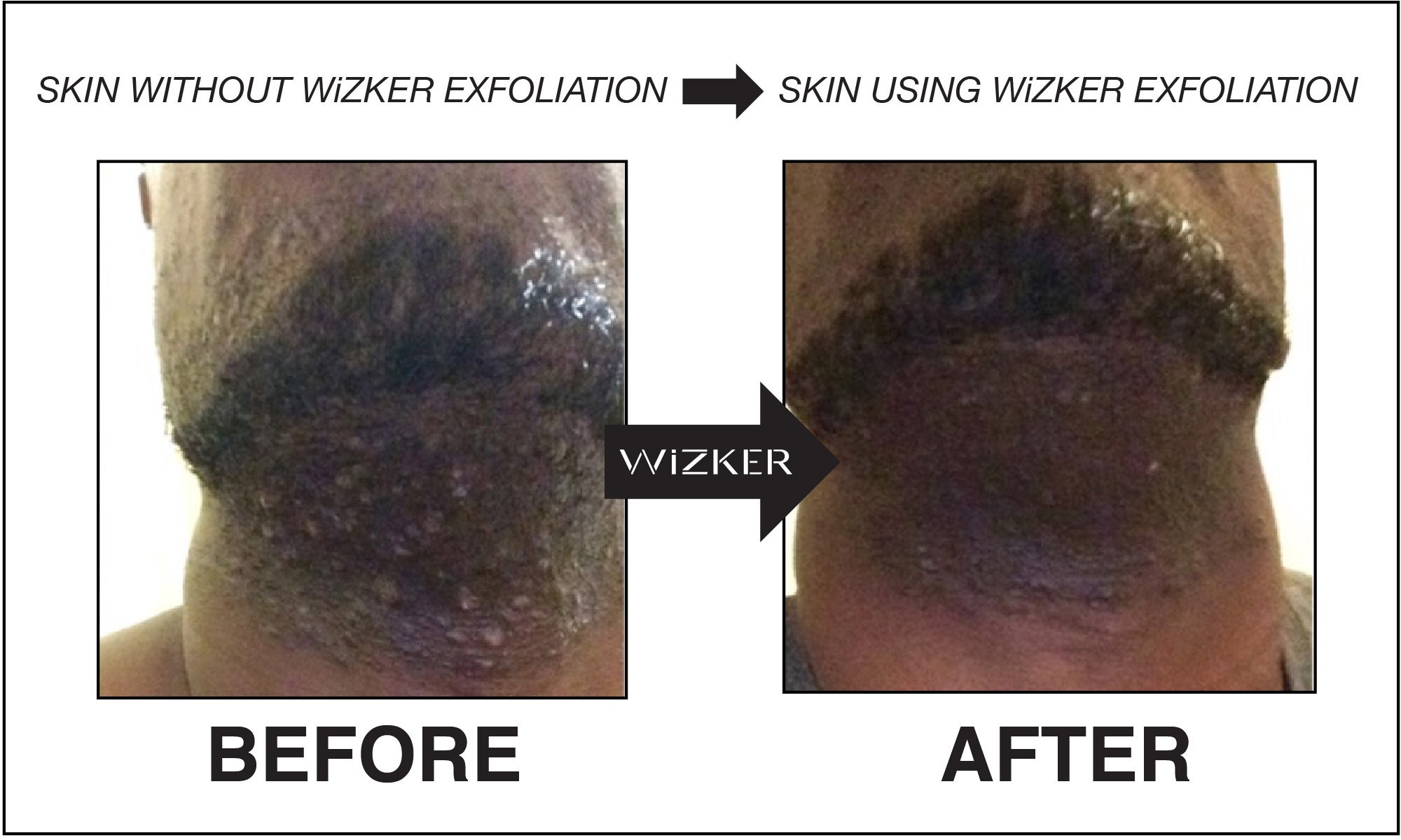 Waterproof Exfoliating Brush Stops Ingrown Hair Razor Bumps