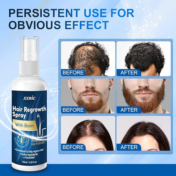 HAIR GROWTH SERUM, HAIR LOSS TREATMENTS FOR MEN & WOMEN, HAIR REGROWTH FOR MEN, HAIR GROWTH OIL SPRAY, COMBAT HAIR LOSS & THINNING HAIR, 100ML