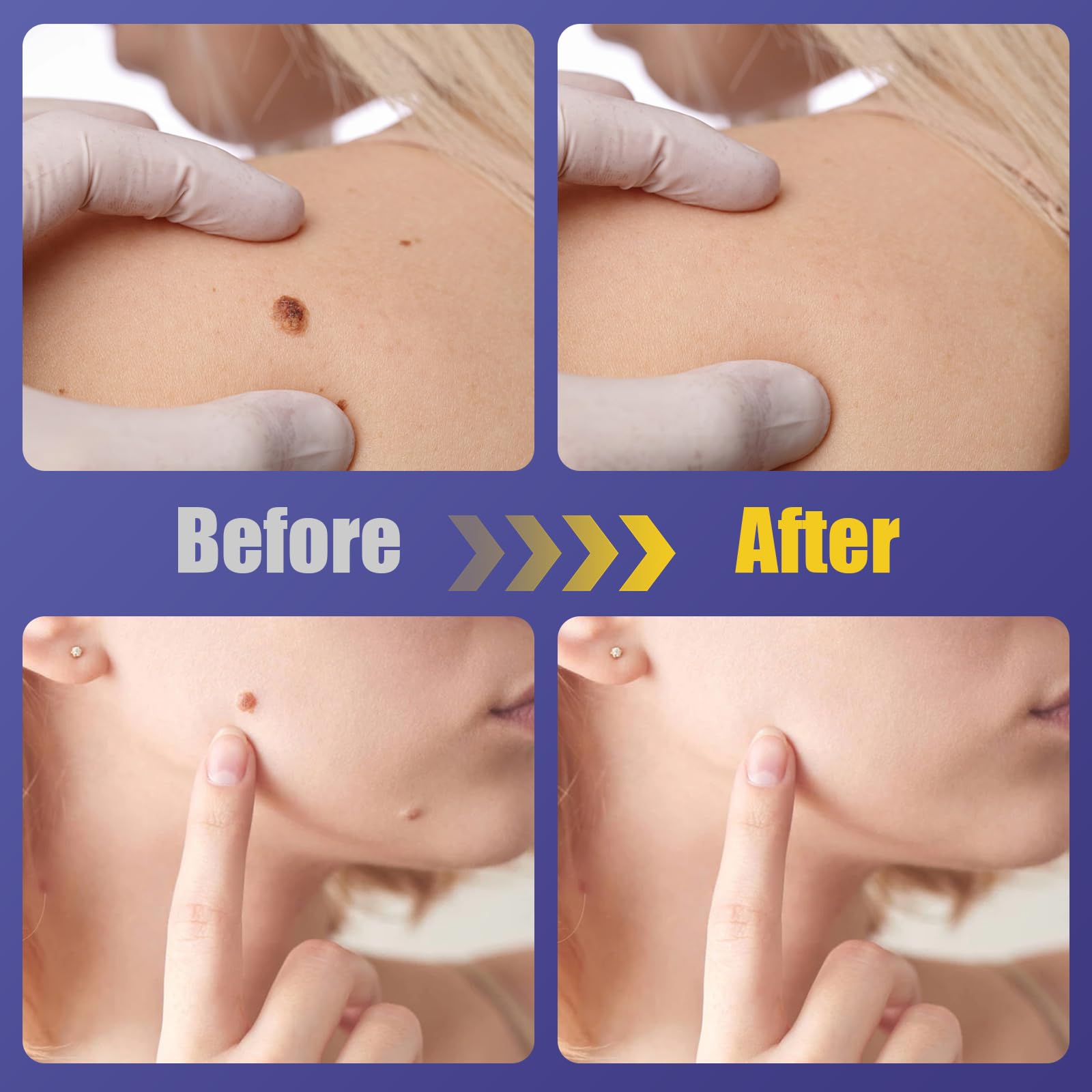 WABRINY Maximum Strength Wart Remover Patches, Fast & Easy Operate Hydrocolloid Waterproof Invisible Sticker, Skin Care Removal Patches for All Skin Types, 144pcs-G3