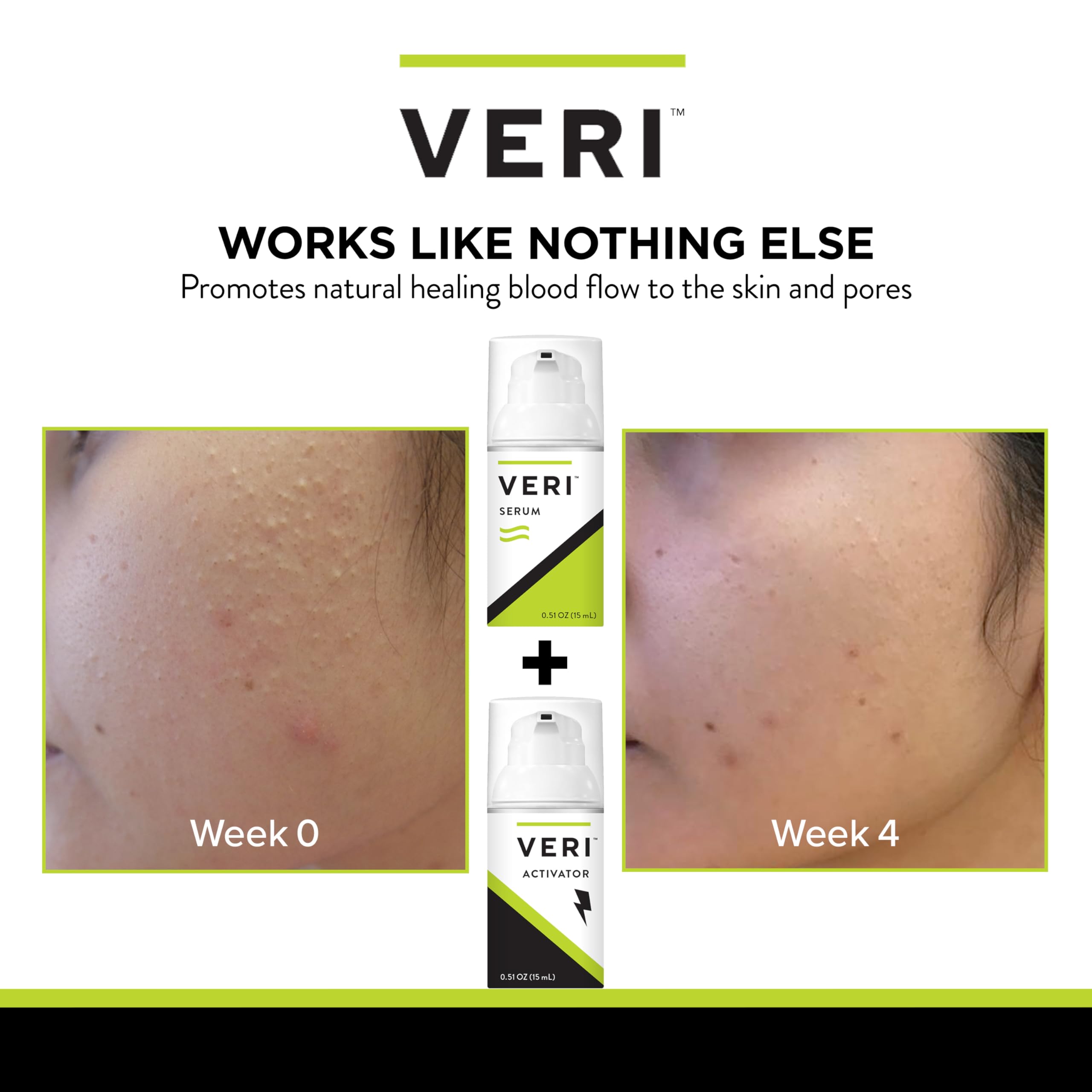 VERI Nitric Oxide + Salicylic Acid Clear Skin System (Peroxide-Free)- For Acne Prone Skin, Unclogs Pores, Clarifies Blemishes, Reduces Inflammation, Prevent Future Breakouts, 30 mL / 1 oz