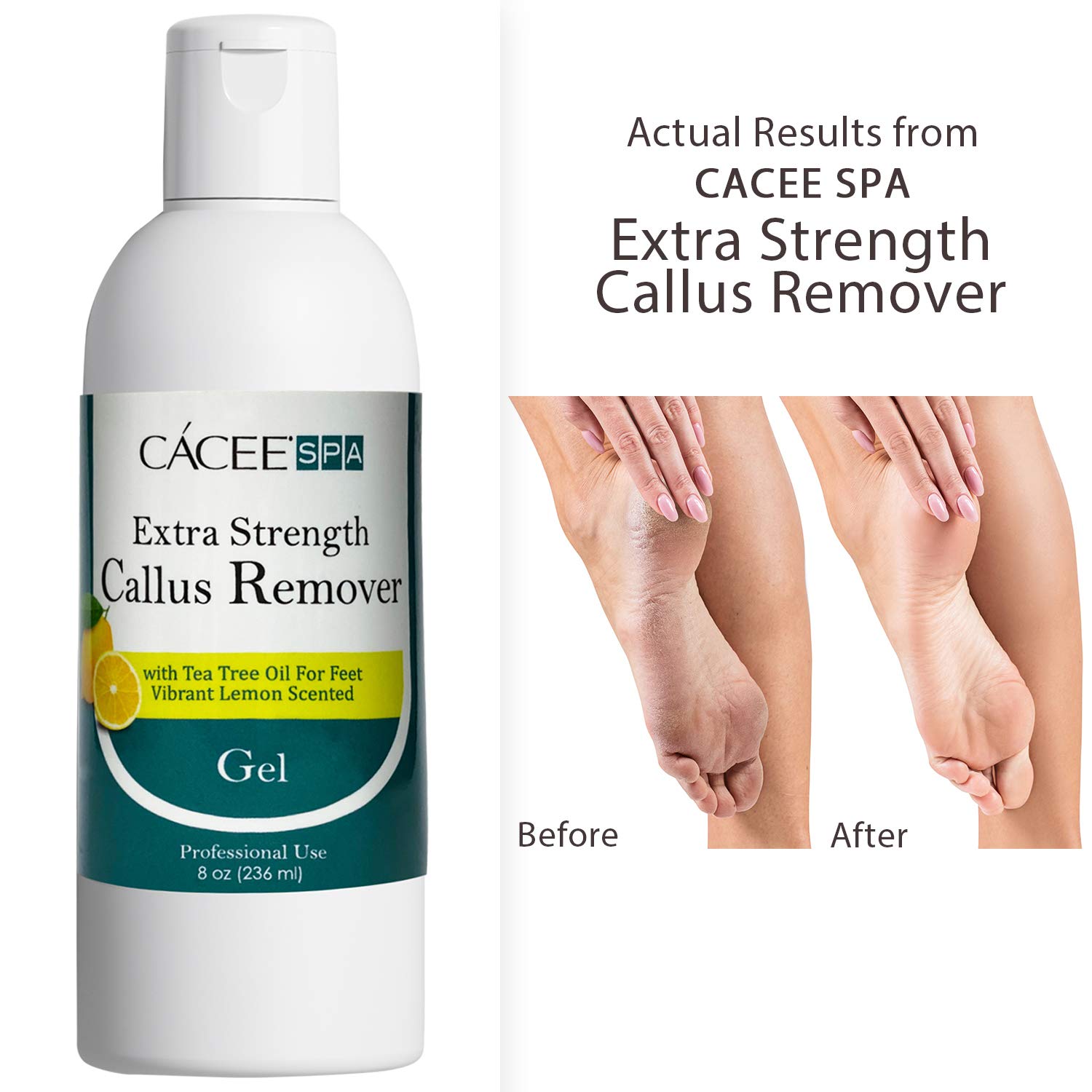 Cacee Callus Remover for Feet 8oz, Gel Formula with Tea Tree Oil & Lemon Scent, Works Great with Foot Scrubber, Foot File, or Pumice Stone, Callous or Corn Remover : Beauty