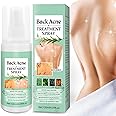 Back Acne Treatment Spray With Herbal Formula, 2% Salicylic Acid & Tea Tree Oil - Body Acne Solution, 120ml