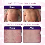 Hope's Relief Intensive Dry Skin Rescue Cream 60g Eczema Psoriasis Dermatitis view 5