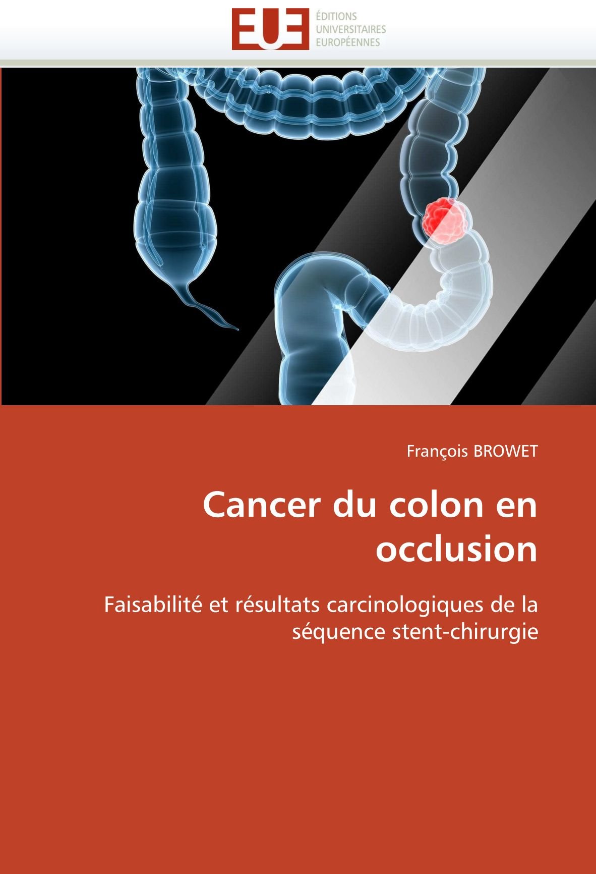 Cancer Du Colon En Occlusion Faisabilite Et Resultats Carcinologiques De La Sequence Stent Chirurgie Omn Univ Europ French Edition Browet Francois Amazon Com Books