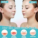 Azonelife 144 Hydrocolloid Acne Patches Face Spots Pimple Treatment Stickers view 6