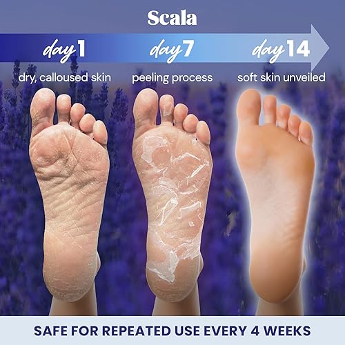 Peeling My Feet So Dry Cracked Scala Foot Peel Mask Treatment (2