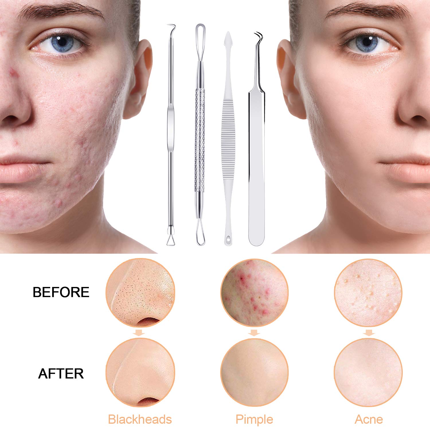 Blackhead Remover Pimple Popper Tool Kit 10 Pcs, Comedone Pimple Extractor Tool, Acne Kit for Blackhead, Whitehead Popping, Zit Removing: Beauty