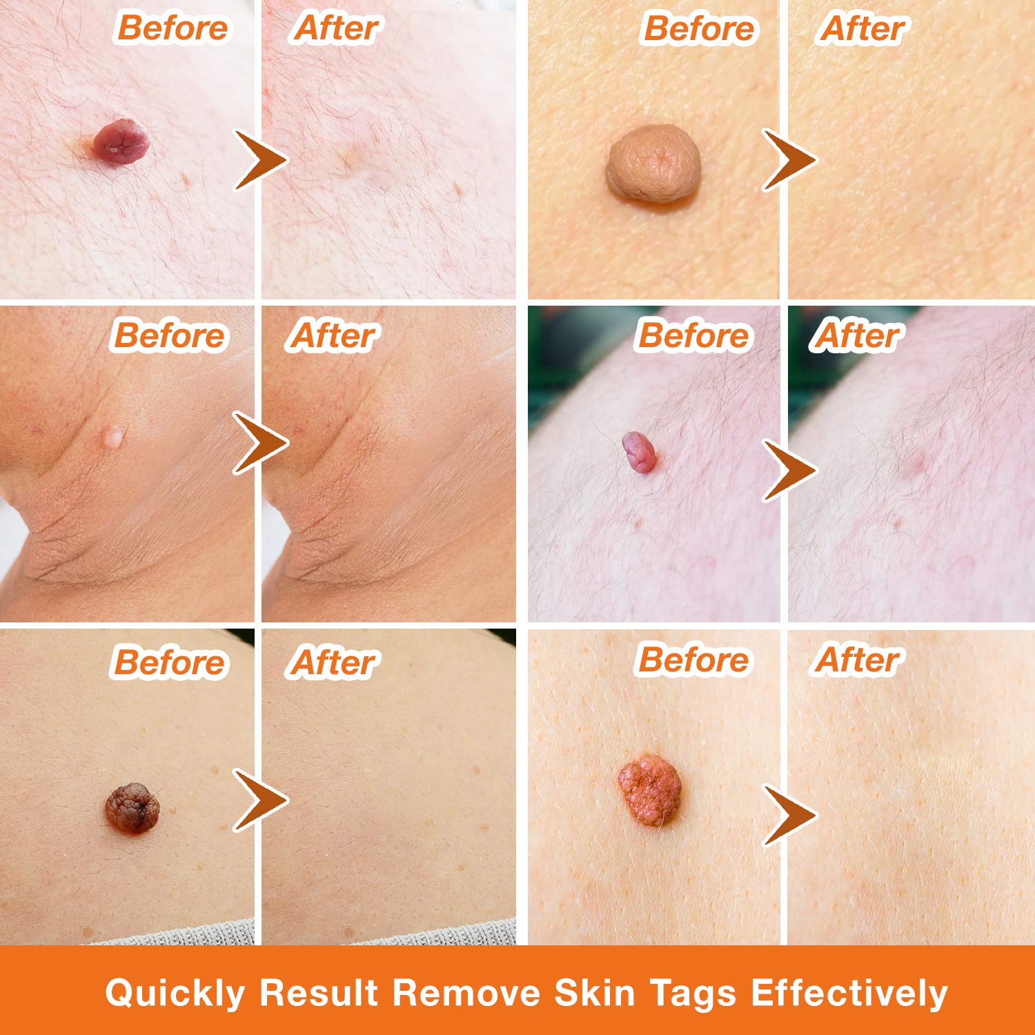 Ulensy Skin Tag Remover, Standard Skin Tag Removal Kit with 36Pcs Repair Patches for Face, Neck, Finger and Body, for Medium to Large (4mm to 8mm) Sized Skin Tags, Safe and Painless, Smooth Results : Beauty