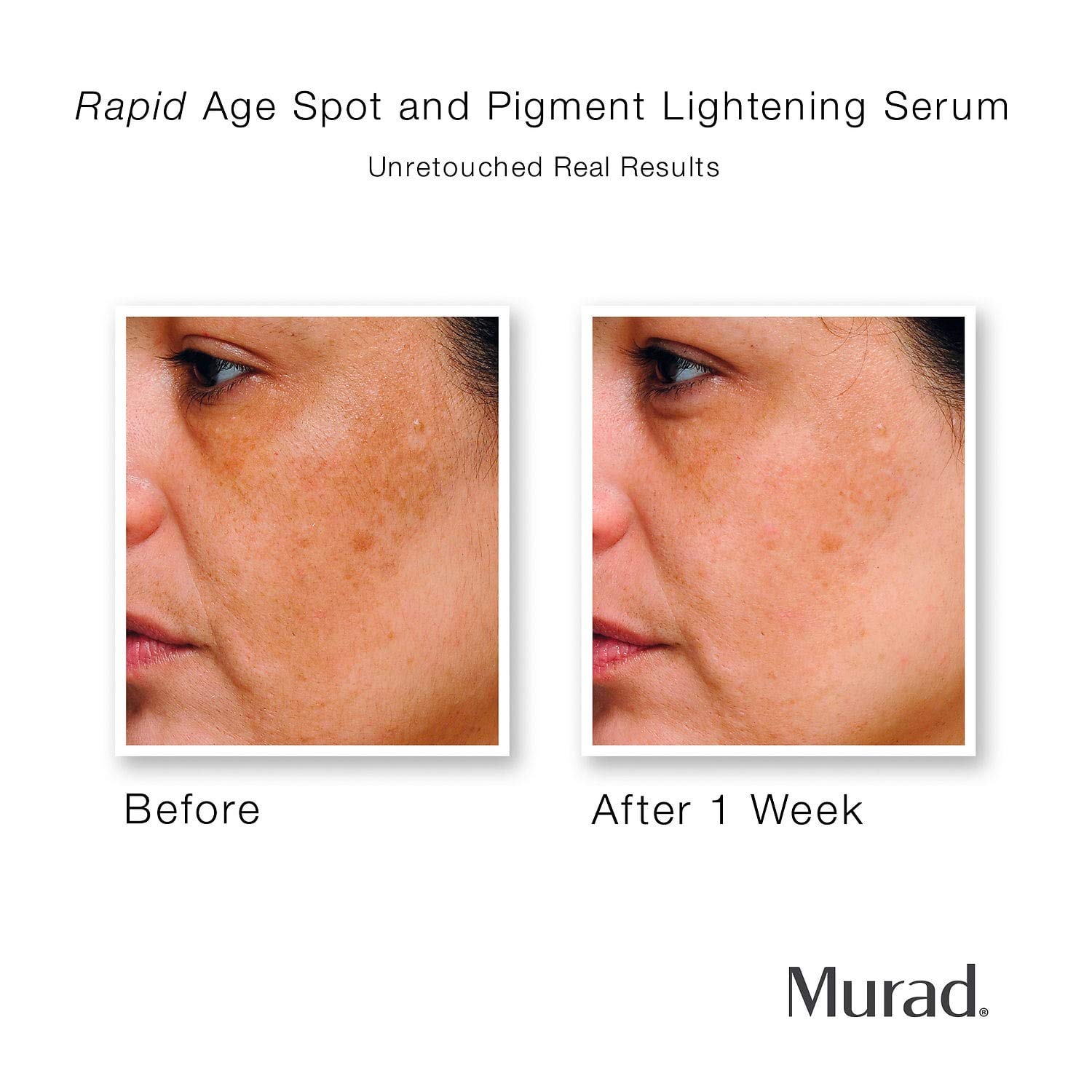 murad rapid age spot and pigment lightening serum pimples