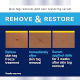 Scholl Complete Care Skin Tag Removal Kit Clinically Safe 12 Treatments view 6