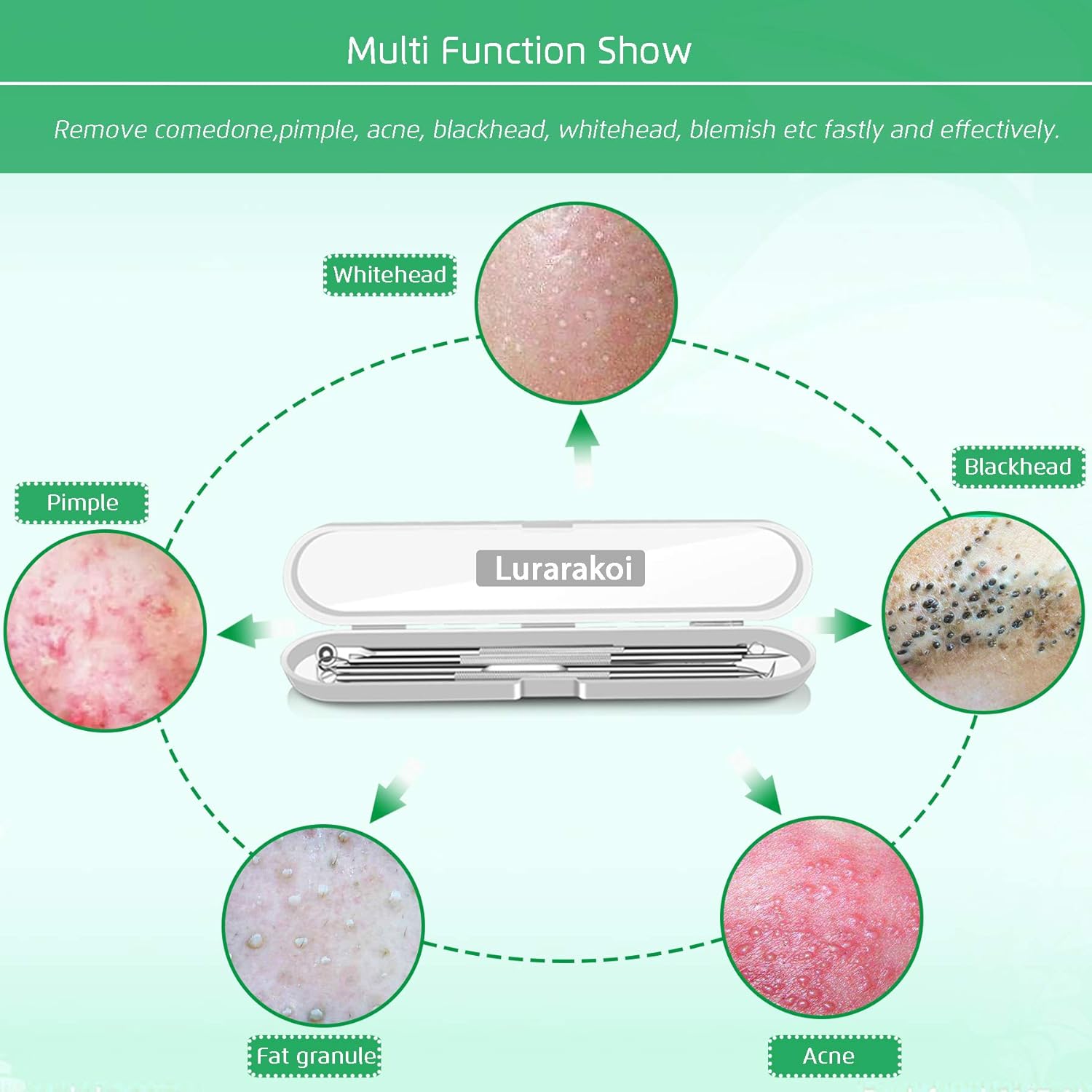 5PCS Blackhead Remover Comedone Extractor, Curved Blackhead Tweezers Kit, Professional Stainless Pimple Acne Blemish Removal Tools Kit: Beauty