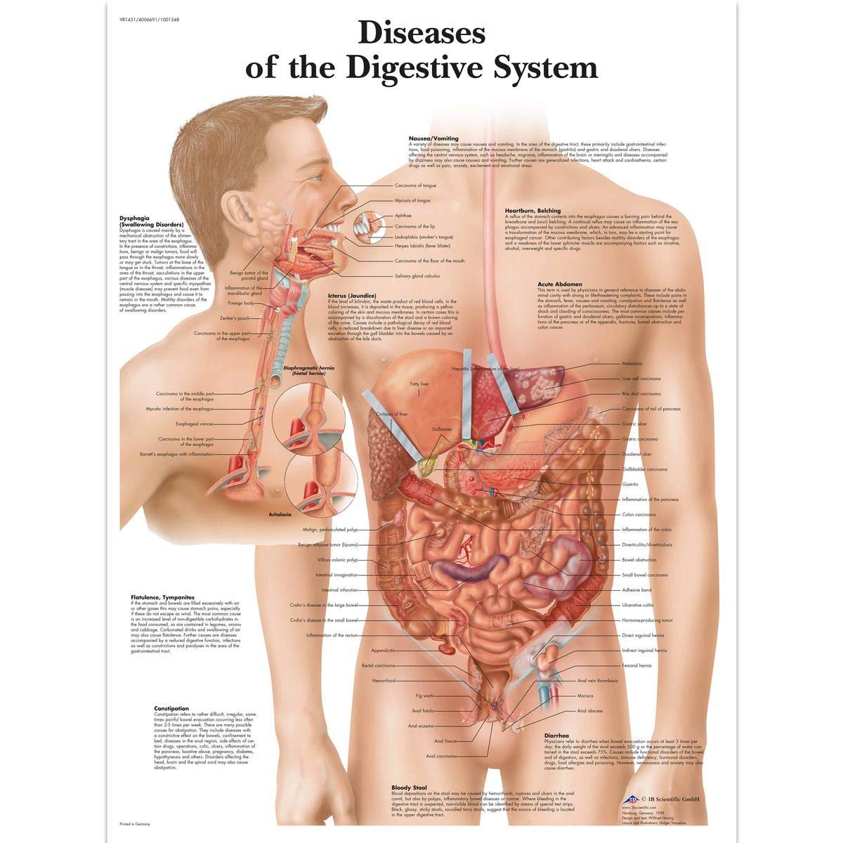 3B Scientific Human Anatomy - Diseases of the Digestive System Chart, Laminated Version