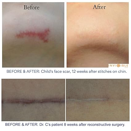 Vitamin E For Acne Scars Before And After - VitaminWalls