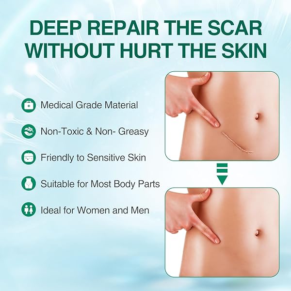 SILICONE SCAR GEL, ADVANCED SCAR TREATMENT CREAM GEL, KELOID BUMP REMOVAL FOR OLD AND NEW SCARS, SURGICAL SCARS, C-SECTION, BURN, STRETCH MARK 1.7 OZ (50G)