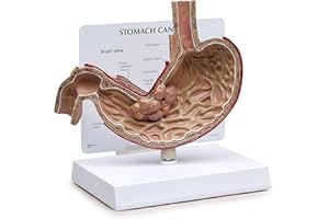 GPI Anatomicals - Stomach Cancer Model, Replica for Human Anatomy and Physiology Education, Anatomy Model for Doctor's Offices and Classrooms, Medical Learning Resources