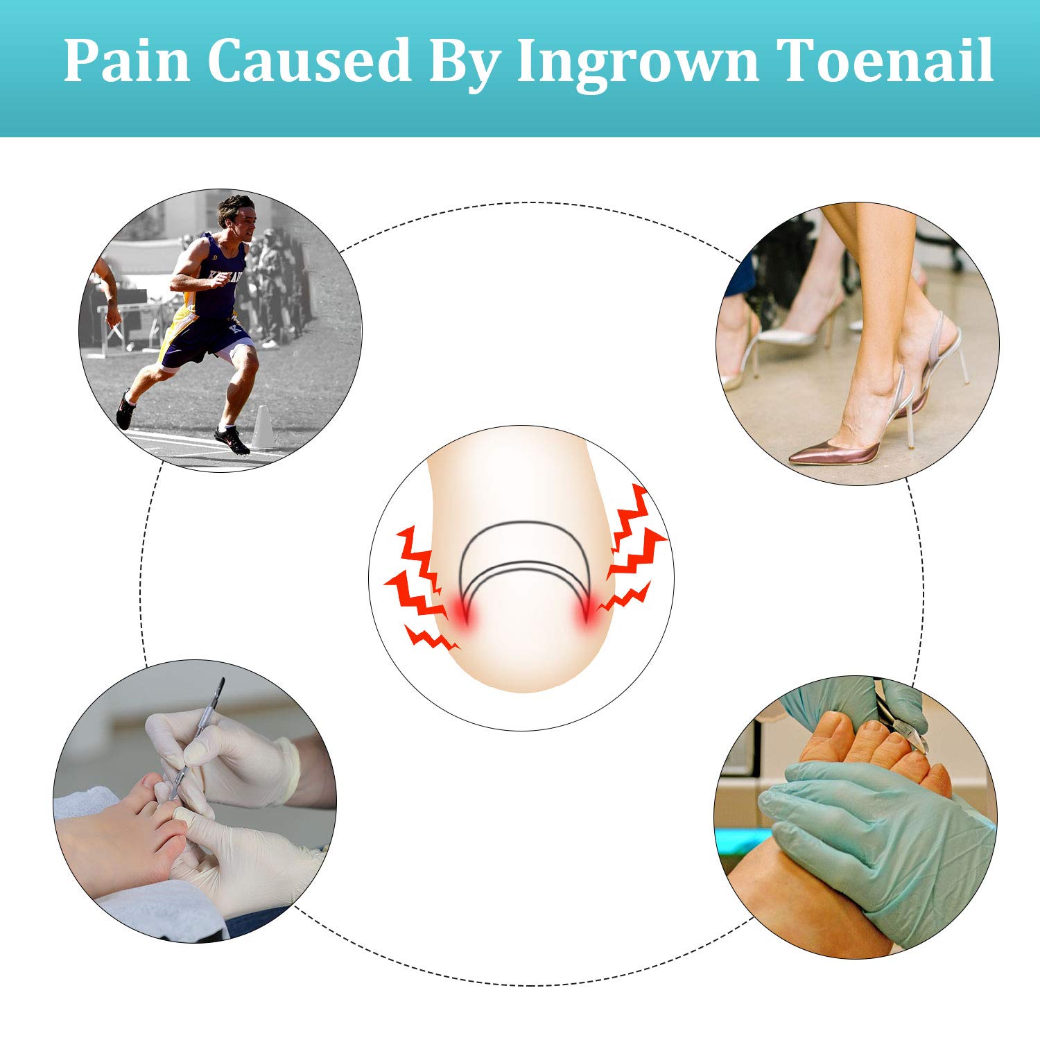 122 Pieces Ingrown Toenail Tool Set, Include Ingrown Toenail File and Lifter, 60 Pieces Elastic Patch Curved Toenails Brace Stickers and 60 Pieces Ingrown Toenail Correction Stickers: Beauty