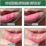 HIVETZ Mouth Ulcer Treatment Spray Herbal Breath Freshener Adults view 2